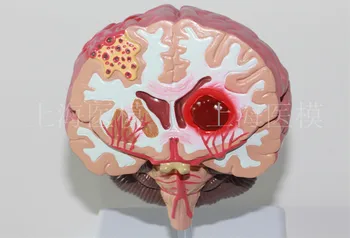 Модель мозгового инсульта церебральный паралич опухоль головного мозга модель заболевания головного мозга модель инсульта неврология модель мозга